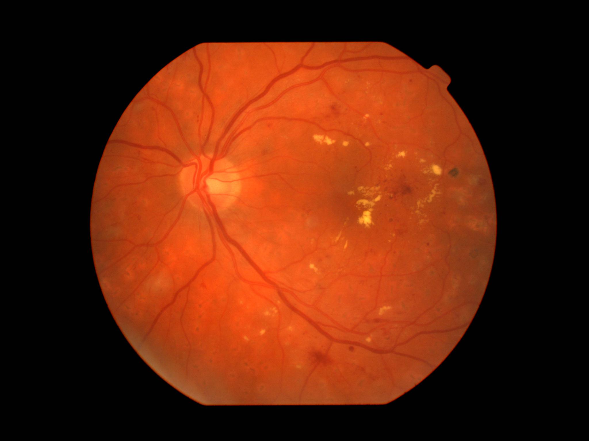 Retinal fundus image from Pugalenthi's foundation-model research